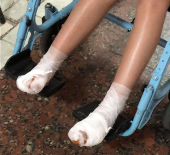 В Вышгороде сотрудники платного водного аттракциона не оказали помощь ребенку с ожогами ног (фото)