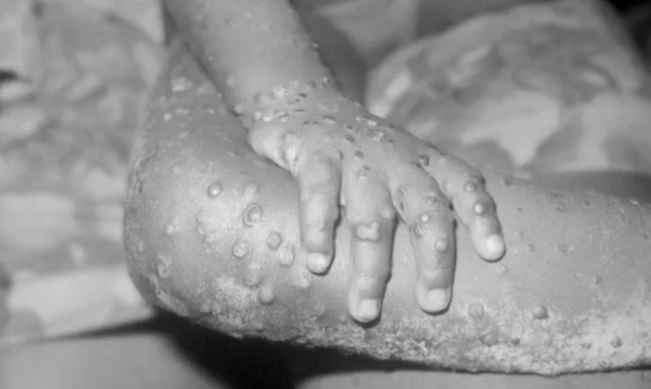 У Міністерстві охорони здоров’я розповіли, що варто знати про вірус мавпячої віспи