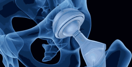 Обухів витратить понад 3 млн гривень на штучні суглоби 